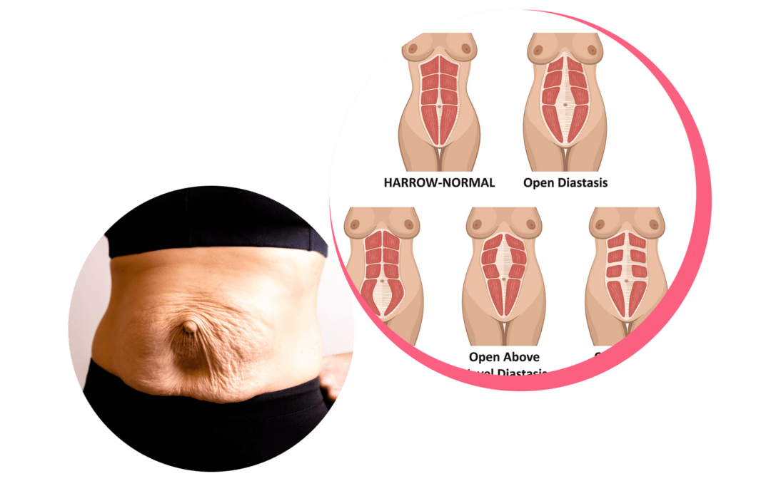 Bauch mit Nabelhernie und Rektusdiastase