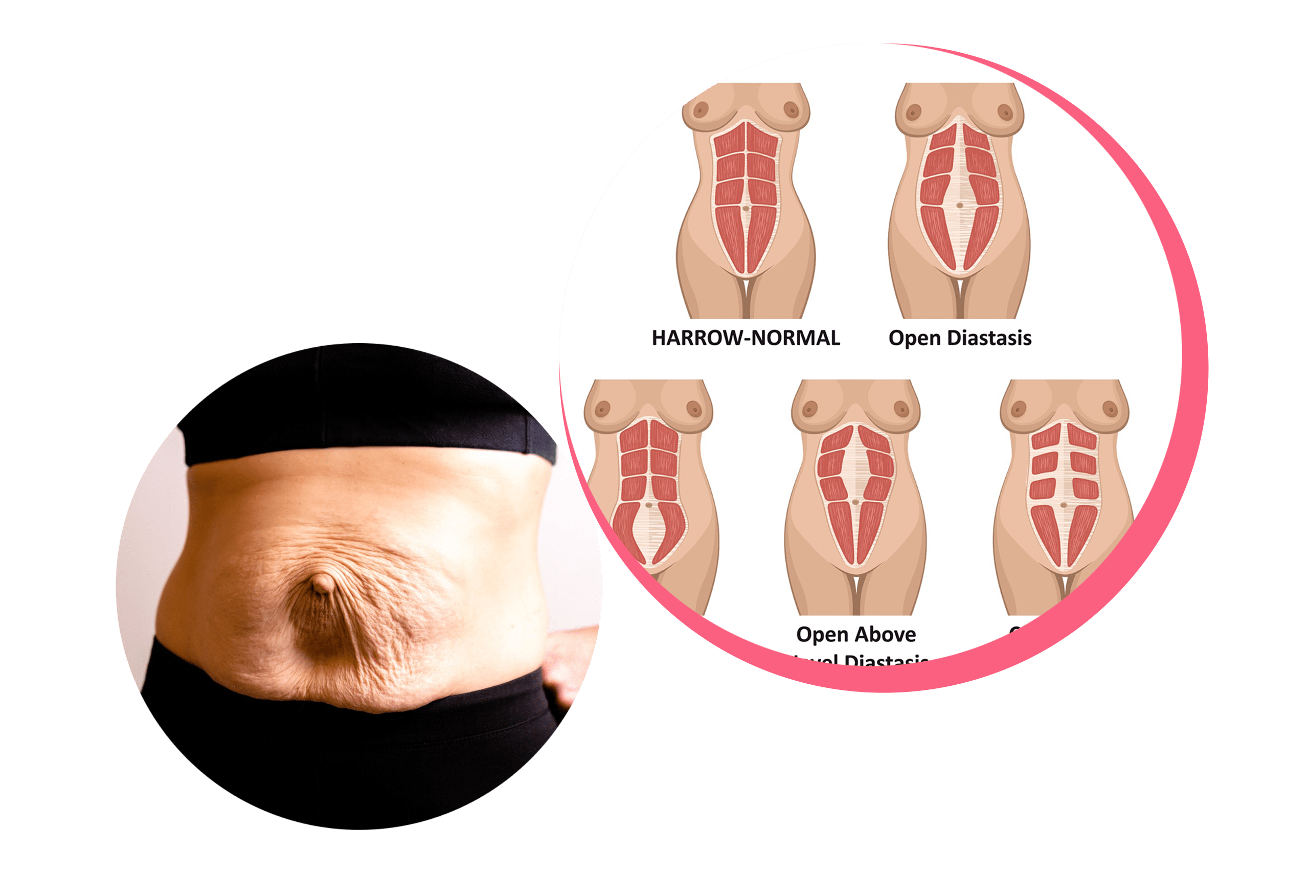 Bauch mit Nabelhernie und Rektusdiastase