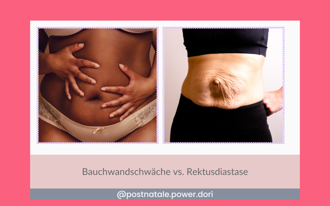 Bauchwandschwäche und Rektusdiastase